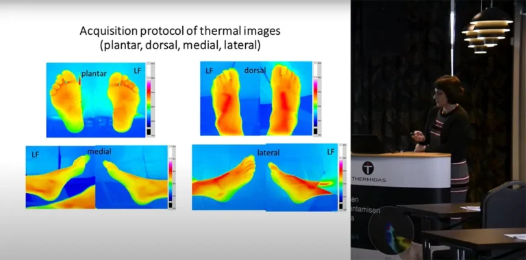 Nina Petrova | Diabetic foot at risk: temperature differences and thermal imaging