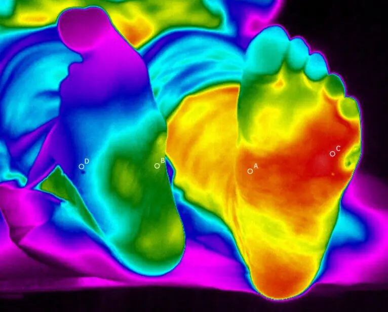 Thermal image of a patient's feet. The left foot is much warmer.